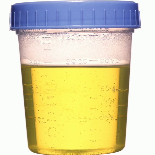 What are some causes of cloudy urine?